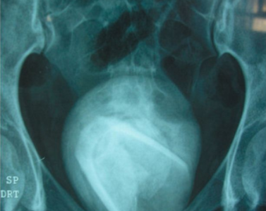 Doctors discover tumbler stuck in woman’s bladder for 4 years after it was used for sexual purpose