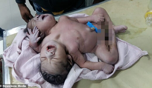 Meet the Baby born with two heads, three arms and two hearts ;Doctors amazed