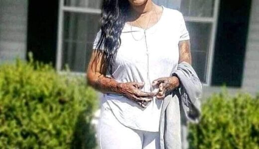 Meet Kanisha Anthony Who Survived a House Fire (Photos)