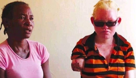 Photo; Thugs Chop Off Hand Of Albino Kid In Zambia