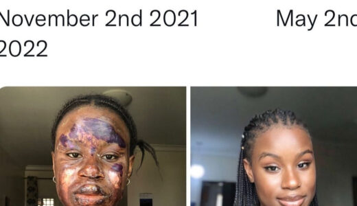 Burn survivor shows off her amazing transformation as skin heals without blemish (Photos)
