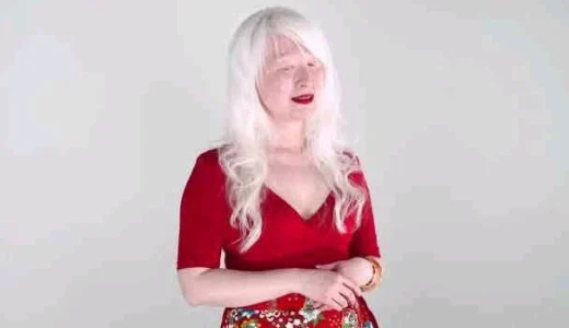 Check Out 8 People With Most Unusual And Unique Skin Color (Photos)