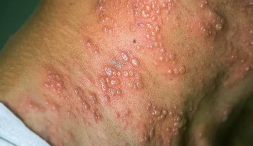 Get Tested For HIV If Any Of The Following 7 Symptoms Start To Appear In Your Body