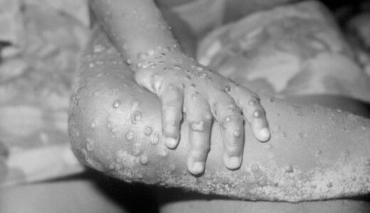 Belgium Becomes First Country In The World To Introduce Mandatory Quarantine For Monkeypox Cases