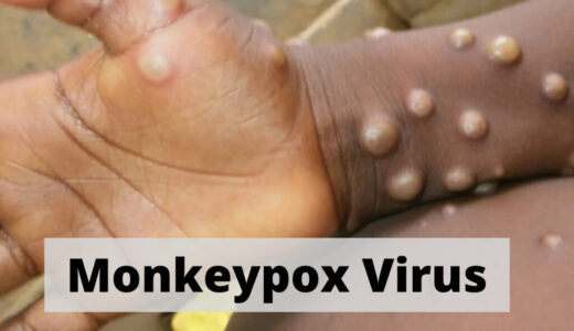 No Monkey pox in Malawi