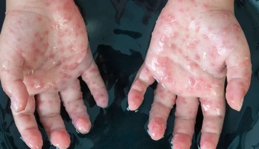 Find out how the illness known as monkeypox might affect you