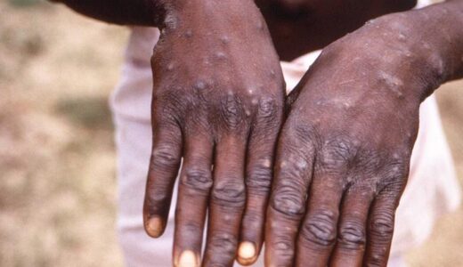 Monkeypox virus may be spread by air, nose masks are advisable
