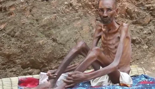 “People Call him Walking Dead” Meet World’s Thinnest Man Who Refused To Die