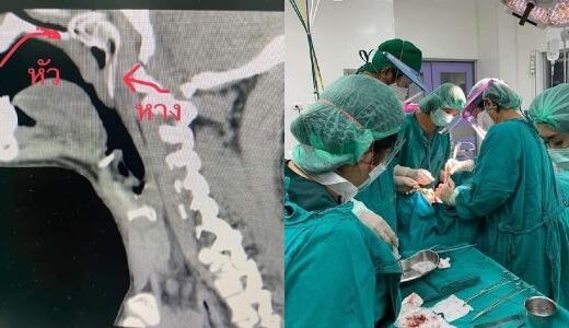 Man Undergoes Surgery After Fish Jumps Out of Water Straight Into His Throat