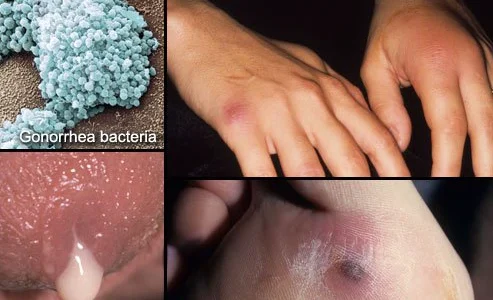 Six Signs of Gonorrhea in a Man and a Woman