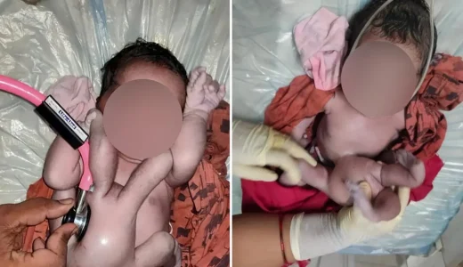Baby Born With 4 Arms, 4 Legs Hailed As A “Miracle Of Nature”