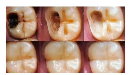 If you have tooth pain, do not go to the dentist, use this tricks to cure dental caries