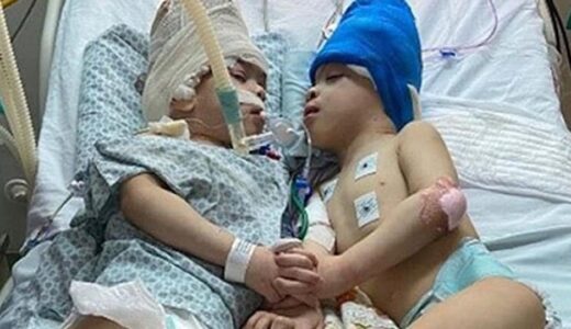 TWINS WHO WERE JOINED AT THE HEAD HAVE BEEN SUCCESSFULLY SEPARATED