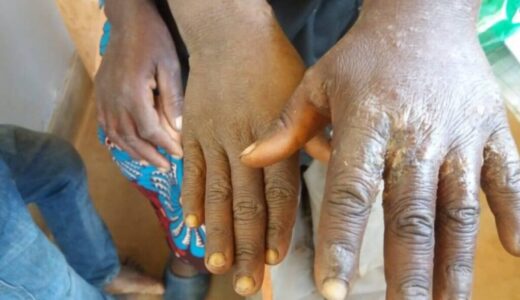 Scabies outbreak hit Cyclone Freddy survivors camps