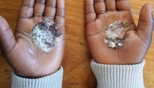 Woman arrested for burning sister in-law’s daughter over Nyika juice